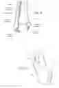 Fig. 07 - Malleolar replacement devices