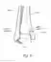Fig. 11 - Malleolar replacement devices