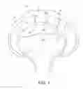 Fig. 02 - Method and instrumentation for acetabular labrum reconstruction