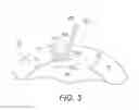 Fig. 04 - Method and instrumentation for acetabular labrum reconstruction