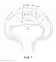 Fig. 08 - Method and instrumentation for acetabular labrum reconstruction