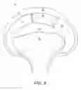Fig. 09 - Method and instrumentation for acetabular labrum reconstruction