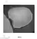 Fig. 04 - Orthotic device for preventing and/or correcting deformational posterior plagiocephaly