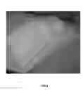 Fig. 07 - Orthotic device for preventing and/or correcting deformational posterior plagiocephaly