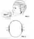 Fig. 03 - Jaw thrust appliance
