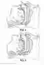Fig. 04 - Jaw thrust appliance