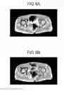 Fig. 08 - Combining multiple MRI data acquisitions having different B1 inhomogeneities