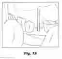 Fig. 02 - SENSOR POSITIONING AND STABILIZING DEVICE