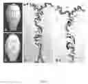 Fig. 04 - Compositions and Methods for Detecting and Treating Implant Loosening and Osteolysis