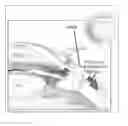 Fig. 01 - IMPROVEMENT TO TRABECULECTOMY