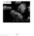 Fig. 05 - Composite of amorphous calcium phosphate/calcium sulfate hemihydrate (CSH/ACP) for bone implantation and process for producing the same