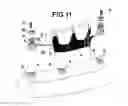 Fig. 12 - 3-PLANS ARTICULATED BAR TO USE IN DENTAL IMPLANTS