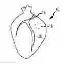 Fig. 01 - APPARATUS AND METHODS FOR SUPPORTING CARDIAC ISCHEMIC TISSUE BY MEANS OF EMBEDDED STRUCTURES