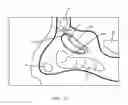 Fig. 04 - Method of confirming location of guide wire