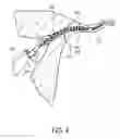 Fig. 05 - Methods for determining lumen occlusion