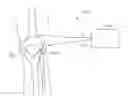 Fig. 01 - METHOD AND DEVICE FOR TREATING OSTEOARTHRITIS NONINVASIVELY