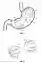 Fig. 02 - Intragastric implants with multiple fluid chambers