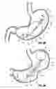 Fig. 06 - Intragastric implants with multiple fluid chambers
