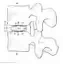 Fig. 01 - Spinal implant with attachable bone securing component