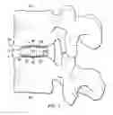 Fig. 02 - Spinal implant with attachable bone securing component