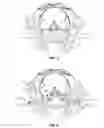 Fig. 03 - Implant system and method for stabilization of a sacro-iliac joint