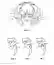 Fig. 04 - Implant system and method for stabilization of a sacro-iliac joint