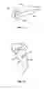 Fig. 06 - Implant system and method for stabilization of a sacro-iliac joint