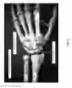 Fig. 02 - METHOD AND APPARATUS FOR DISTAL RADIOULNAR JOINT (DRUJ) ARTHROPLASTY