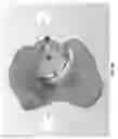 Fig. 29 - METHOD AND APPARATUS FOR DISTAL RADIOULNAR JOINT (DRUJ) ARTHROPLASTY
