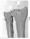 Fig. 30 - METHOD AND APPARATUS FOR DISTAL RADIOULNAR JOINT (DRUJ) ARTHROPLASTY