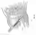 Fig. 34 - METHOD AND APPARATUS FOR DISTAL RADIOULNAR JOINT (DRUJ) ARTHROPLASTY