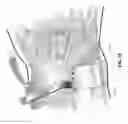 Fig. 35 - METHOD AND APPARATUS FOR DISTAL RADIOULNAR JOINT (DRUJ) ARTHROPLASTY