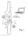 Fig. 02 - Hermetically sealed prosthetic component and method therefor