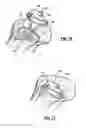 Fig. 07 - Total knee joint mold and methods