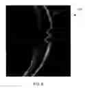 Fig. 07 - COMPUTER-AIDED DIAGNOSIS OF RETINAL PATHOLOGIES USING FRONTAL EN-FACE VIEWS OF OPTICAL COHERENCE TOMOGRAPHY