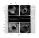 Fig. 08 - COMPUTER-AIDED DIAGNOSIS OF RETINAL PATHOLOGIES USING FRONTAL EN-FACE VIEWS OF OPTICAL COHERENCE TOMOGRAPHY