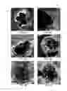 Fig. 09 - COMPUTER-AIDED DIAGNOSIS OF RETINAL PATHOLOGIES USING FRONTAL EN-FACE VIEWS OF OPTICAL COHERENCE TOMOGRAPHY