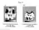 Fig. 11 - Medical image display processing method, device, and program