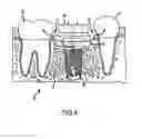 Fig. 07 - Angled dental platform assembly and methods