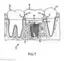 Fig. 08 - Angled dental platform assembly and methods