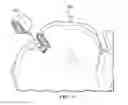 Fig. 06 - ELECTROSURGICAL SYSTEM AND METHOD FOR TREATING HARD BODY TISSUE