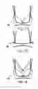 Fig. 12 - Garment for providing body shaping