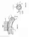 Fig. 02 - Systems and Methods Which Remove Material From Blood Vessel Walls