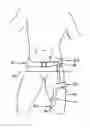 Fig. 01 - Hip orthosis, method for preventing the dislocation of a hip and use of a hip orthosis