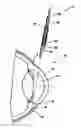 Fig. 01 - METHODS, SYSTEMS AND APPARATUS FOR RELIEVING PRESSURE IN AN ORGAN
