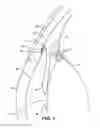 Fig. 02 - Intraocular implants and methods and kits therefor