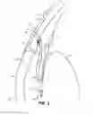 Fig. 03 - Intraocular implants and methods and kits therefor