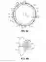 Fig. 05 - Intraocular implants and methods and kits therefor