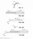 Fig. 16 - Intraocular implants and methods and kits therefor