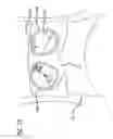 Fig. 30 - Robotic surgical systems with fluid flow control for irrigation, aspiration, and blowing